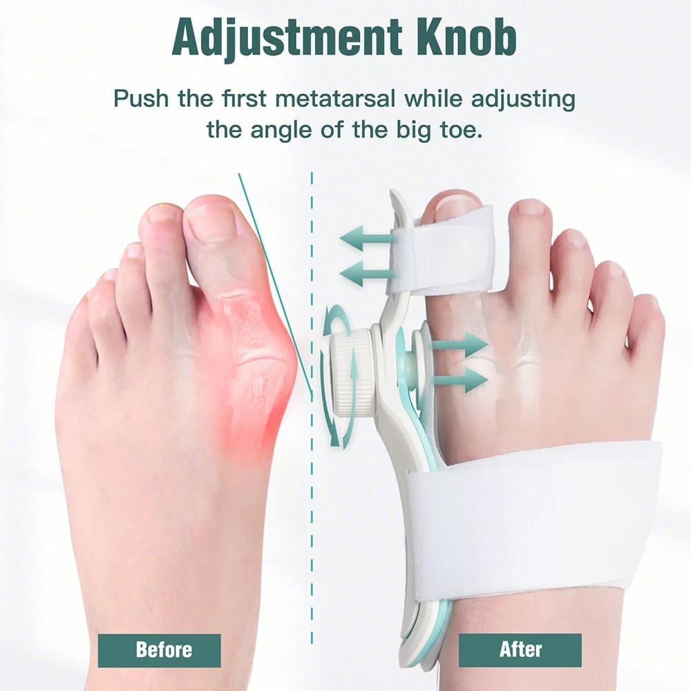 Ortopedisk bunion corrector, hallux valgus corrector på foten